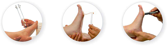 Der diabetische Fuß und seine Diagnose. Neben der Sichtkontrolle haben sich verschiedene diagnostische Hilfsmittel bewährt: Stimmgabel, Monofilament und Tip Therm. (Foto: www.schein.de) Der diabetische Fuß und seine Diagnose. Neben der Sichtkontrolle haben sich verschiedene diagnostische Hilfsmittel bewährt: Stimmgabel, Monofilament und Tip Therm. (Foto: www.schein.de)